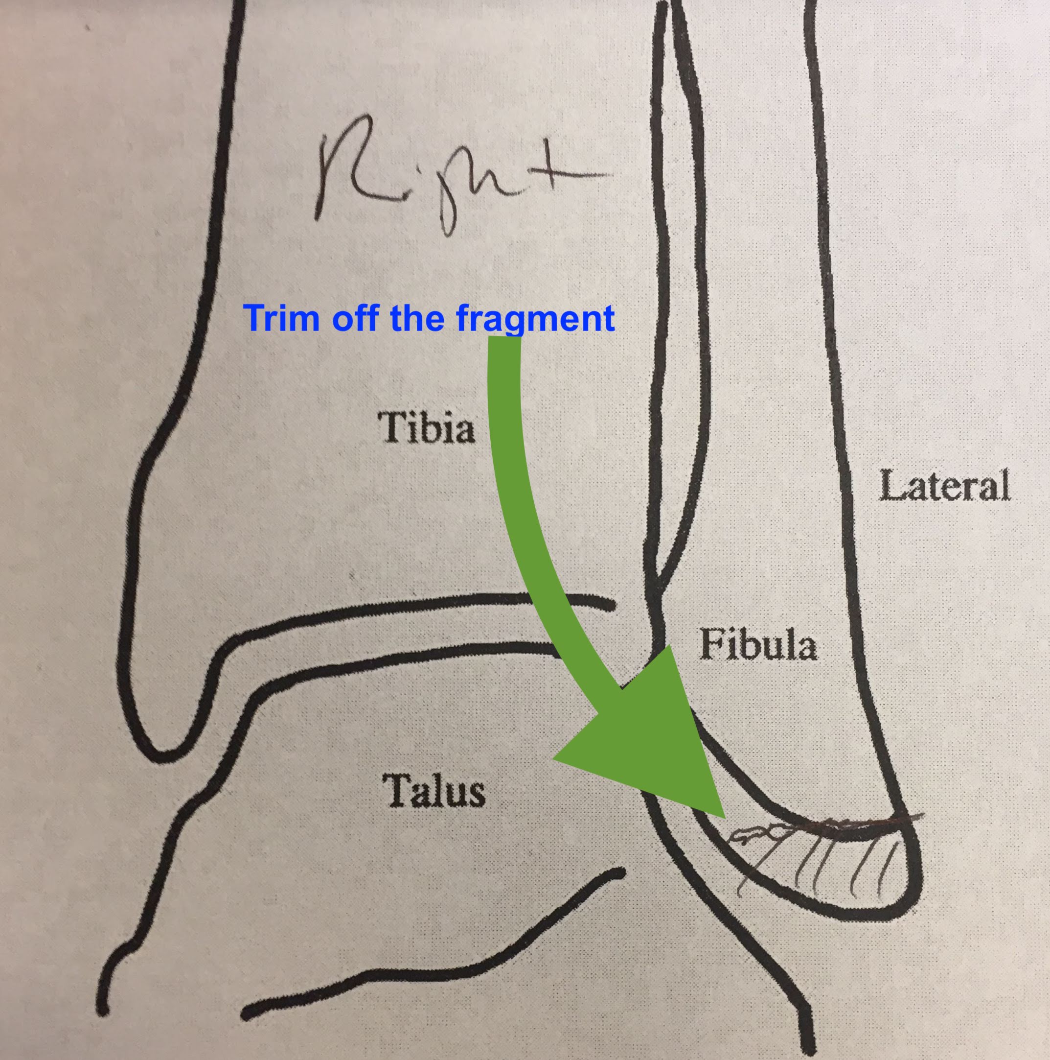 Ankle Surgery Drawing